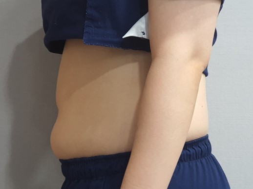 산삼비만약침 복부 시술 6회입니다. 진료 전 사진